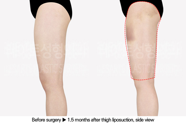 thigh_liposuction_02_04_240701