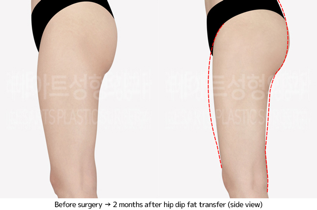 thigh_liposuction_02_04_240703