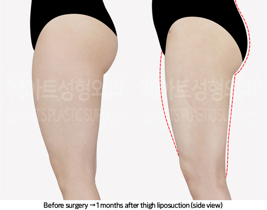 thigh_liposuction_02_04_240711