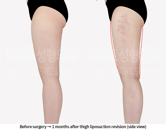 thigh_liposuction_02_04_240715