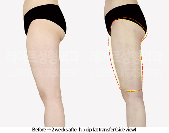 thigh_liposuction_02_04_240805
