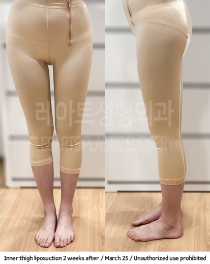 thigh_liposuction_02_05_231229