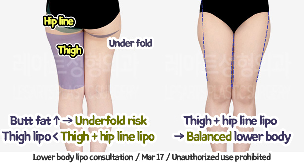thigh_liposuction_02_05_240109