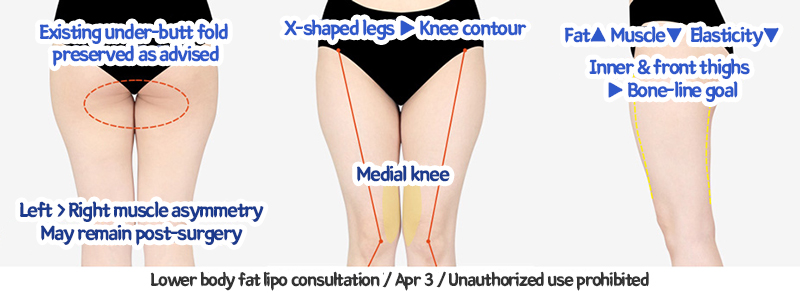 thigh_liposuction_02_05_240124