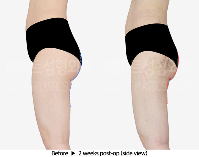 thigh_liposuction_02_05_240401