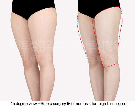 thigh_liposuction_02_05_240517