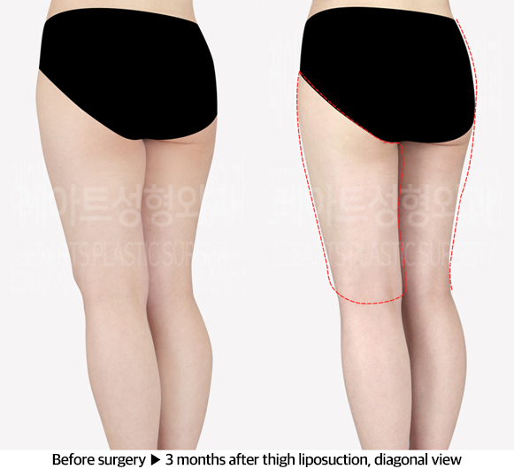 thigh_liposuction_02_05_240603