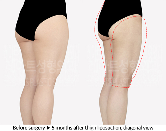 thigh_liposuction_02_05_240607