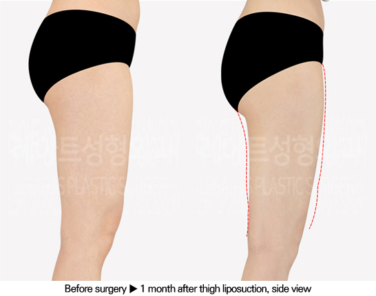 thigh_liposuction_02_05_240613