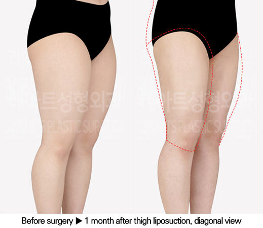 thigh_liposuction_02_05_240618