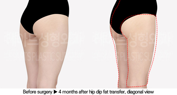 thigh_liposuction_02_05_240628