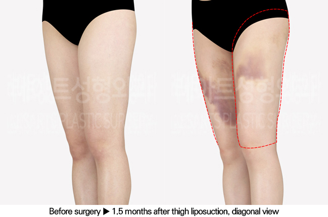thigh_liposuction_02_05_240701