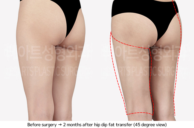 thigh_liposuction_02_05_240703