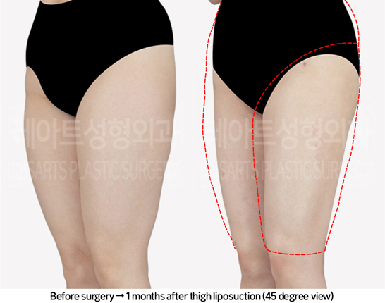 thigh_liposuction_02_05_240711