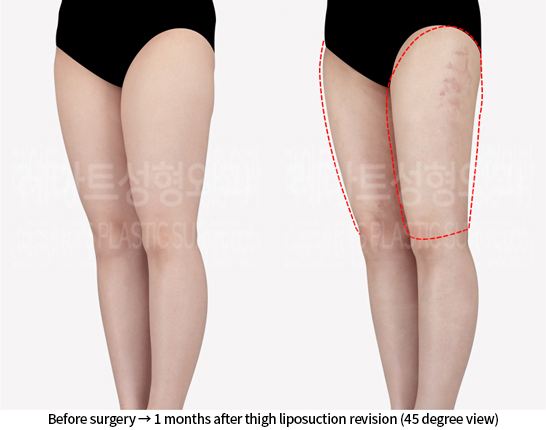 thigh_liposuction_02_05_240715