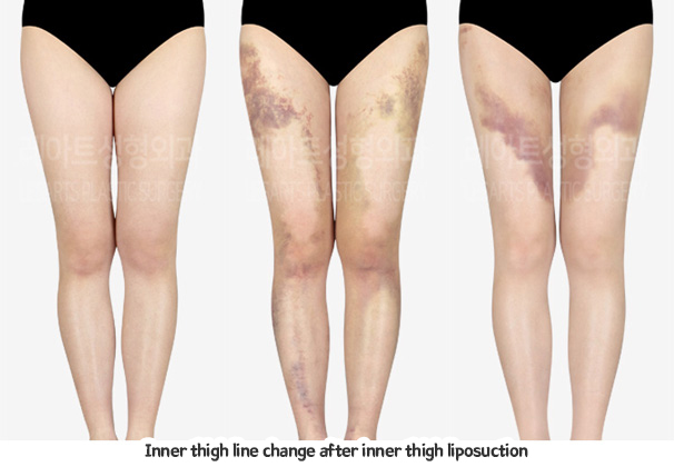 thigh_liposuction_02_06_231229