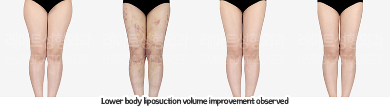 thigh_liposuction_02_06_240109