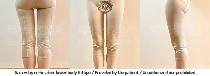 thigh_liposuction_02_06_240124