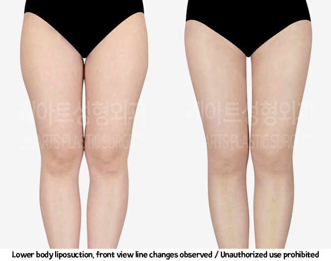 thigh_liposuction_02_06_240220