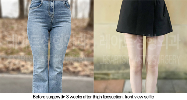 thigh_liposuction_02_06_240613