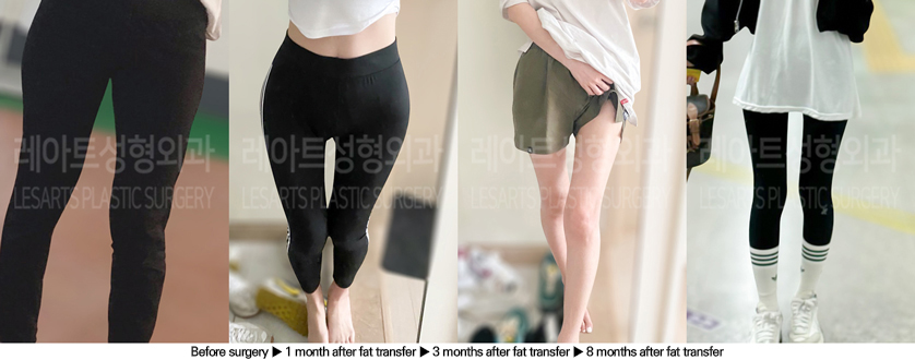thigh_liposuction_02_06_240628