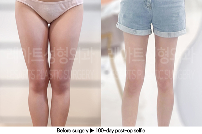 thigh_liposuction_02_06_240701
