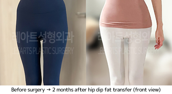 thigh_liposuction_02_06_240703