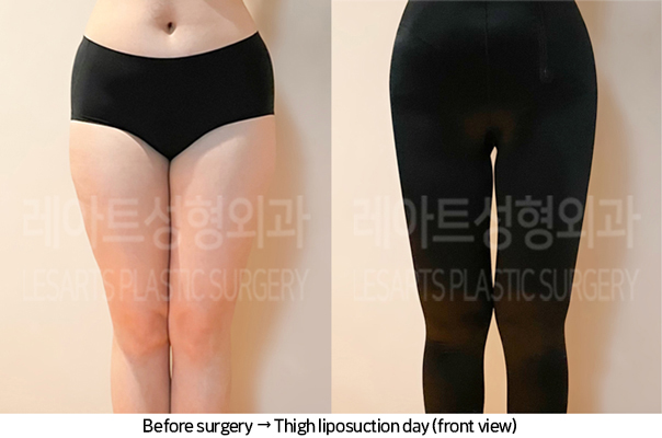 thigh_liposuction_02_06_240711