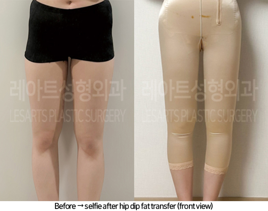 thigh_liposuction_02_06_240805