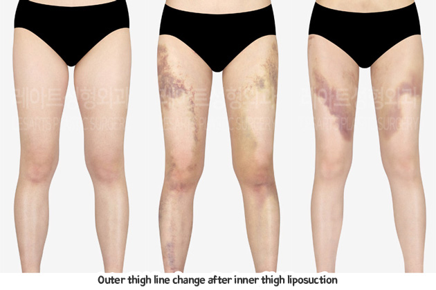 thigh_liposuction_02_07_231229