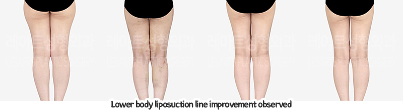 thigh_liposuction_02_07_240109