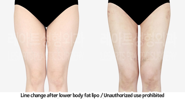 thigh_liposuction_02_07_240124