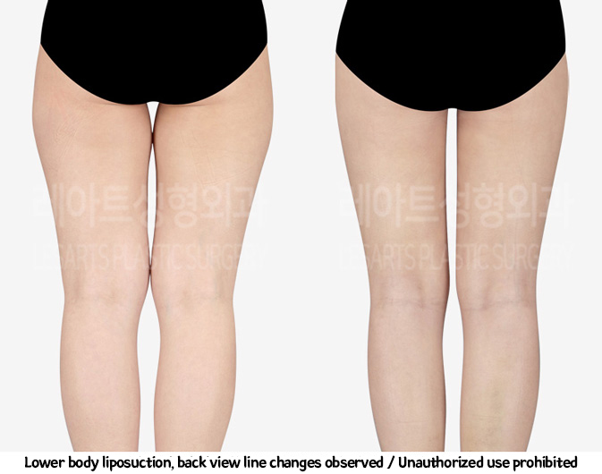 thigh_liposuction_02_07_240220