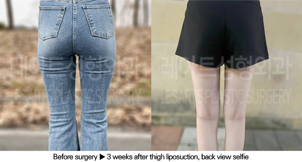 thigh_liposuction_02_07_240613