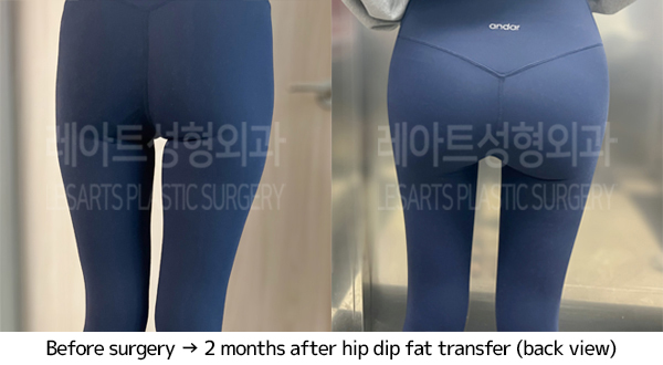thigh_liposuction_02_07_240703