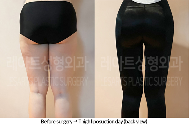 thigh_liposuction_02_07_240711