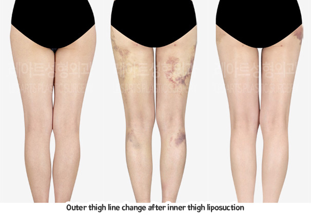 thigh_liposuction_02_08_231229