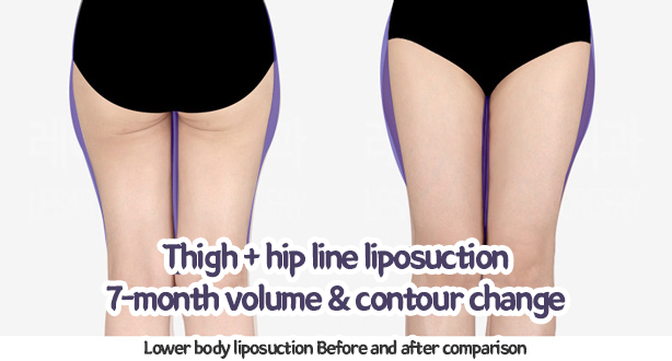 thigh_liposuction_02_08_240109
