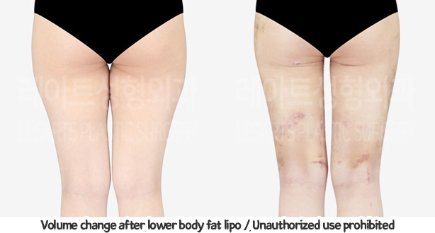 thigh_liposuction_02_08_240124