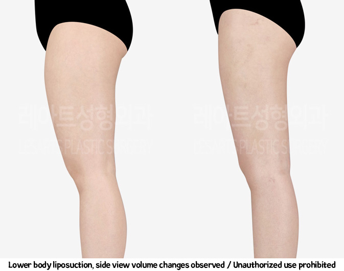 thigh_liposuction_02_08_240220