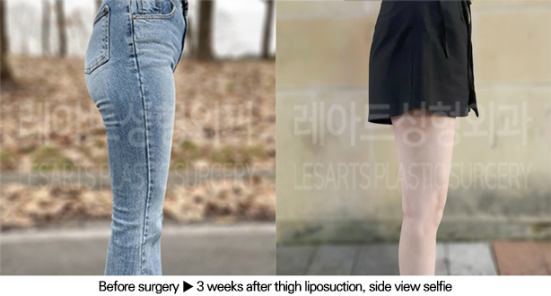thigh_liposuction_02_08_240613