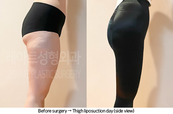thigh_liposuction_02_08_240711