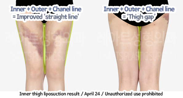 thigh_liposuction_02_09_231229