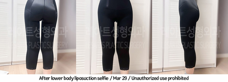 thigh_liposuction_02_09_240109