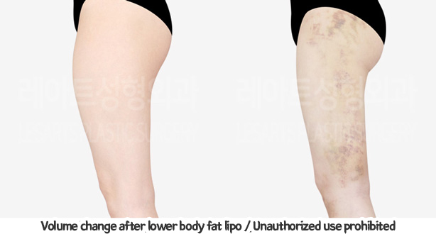thigh_liposuction_02_09_240124