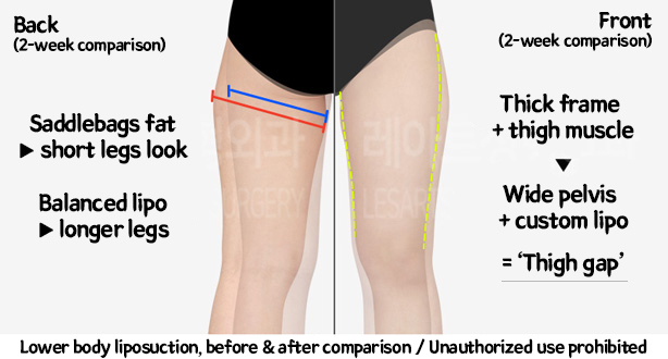 thigh_liposuction_02_09_240220