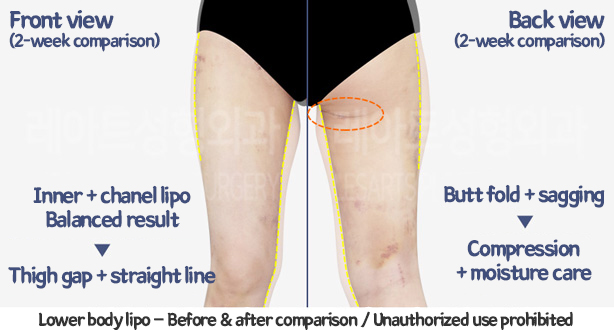 thigh_liposuction_02_10_240124