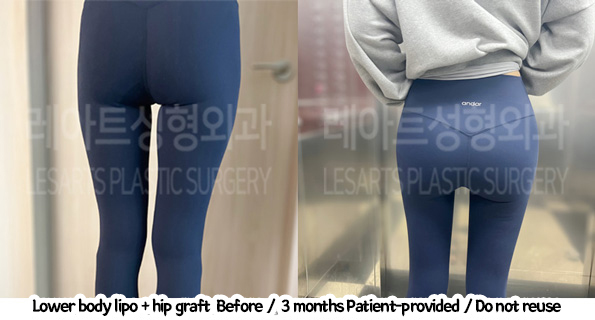 thigh_liposuction_02_231thigh_iposuction-hip_fat_grafting_02__01231226215