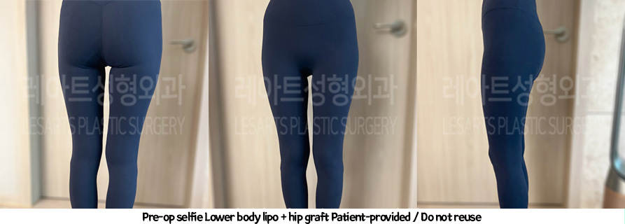 thigh_liposuction_02_231thigh_iposuction-hip_fat_grafting_04_01231226215