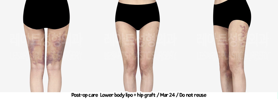 thigh_liposuction_02_231thigh_iposuction-hip_fat_grafting_06_01231226215